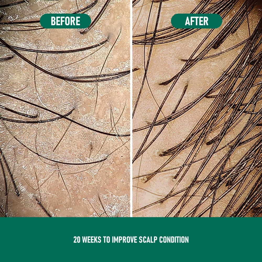 Minoxidil Hair Growth Mousse – Anti Hair Loss Foam