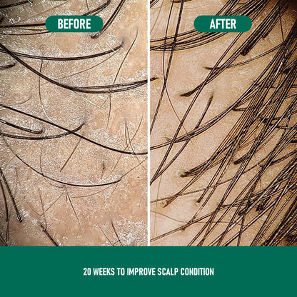 Minoxidil Hair Growth Mousse – Anti Hair Loss Foam