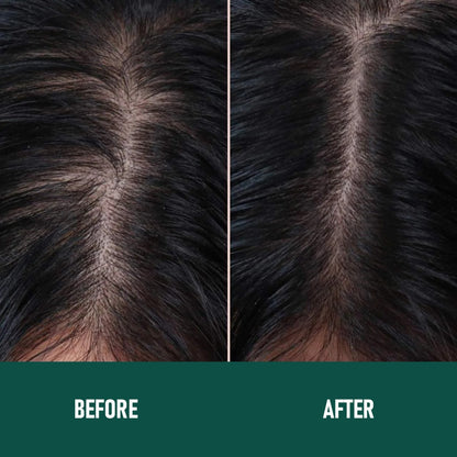 Minoxidil Hair Growth Mousse – Anti Hair Loss Foam