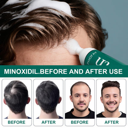 Minoxidil Hair Growth Mousse – Anti Hair Loss Foam